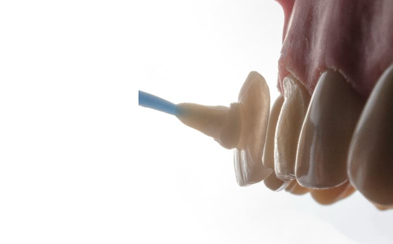 Чи шкідливі вініри: чесний погляд