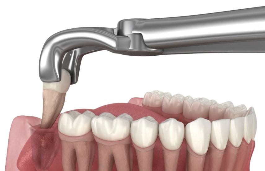 Нюанси видалення «зуба мудрості» без анестезії